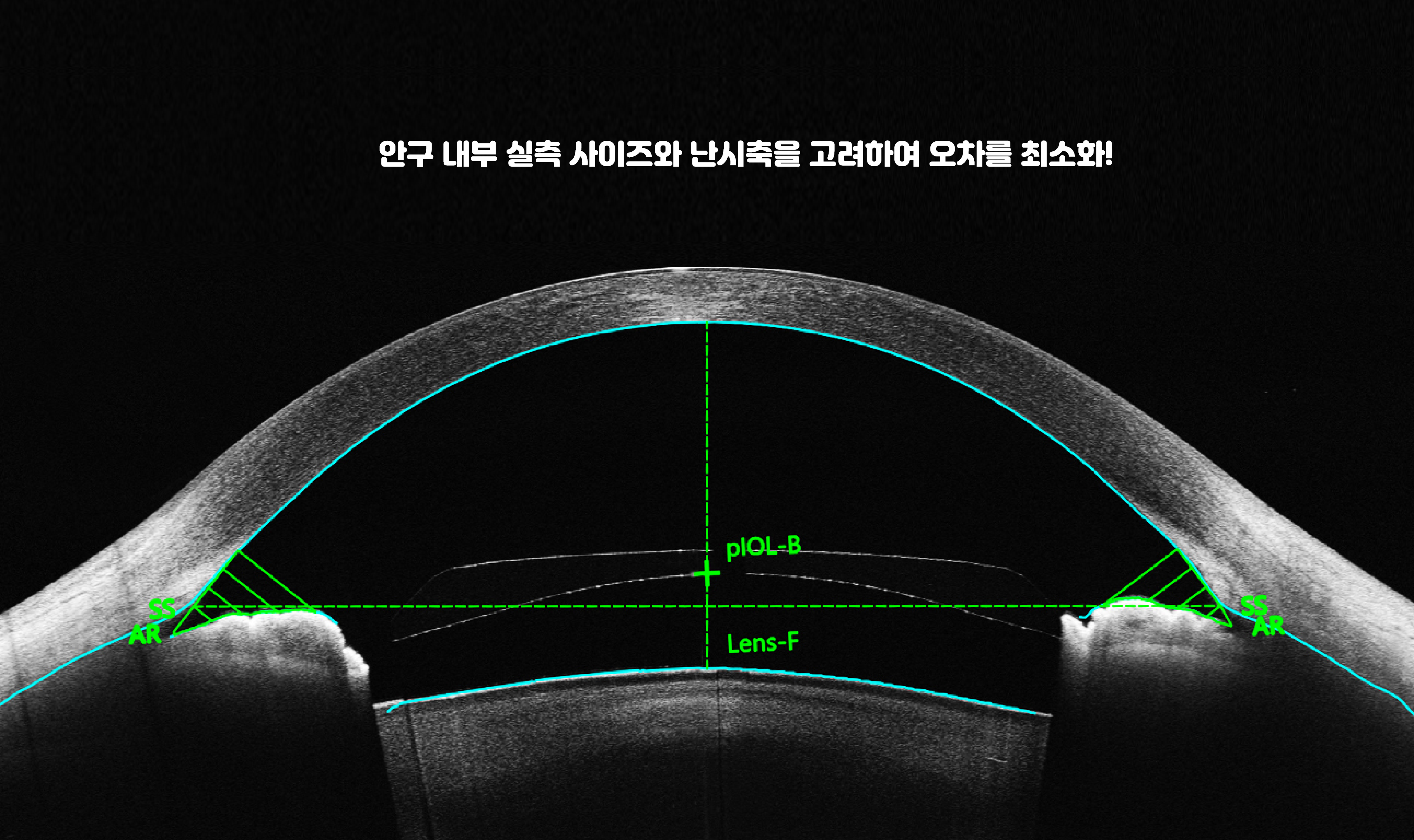 렌즈삽입술 14 1