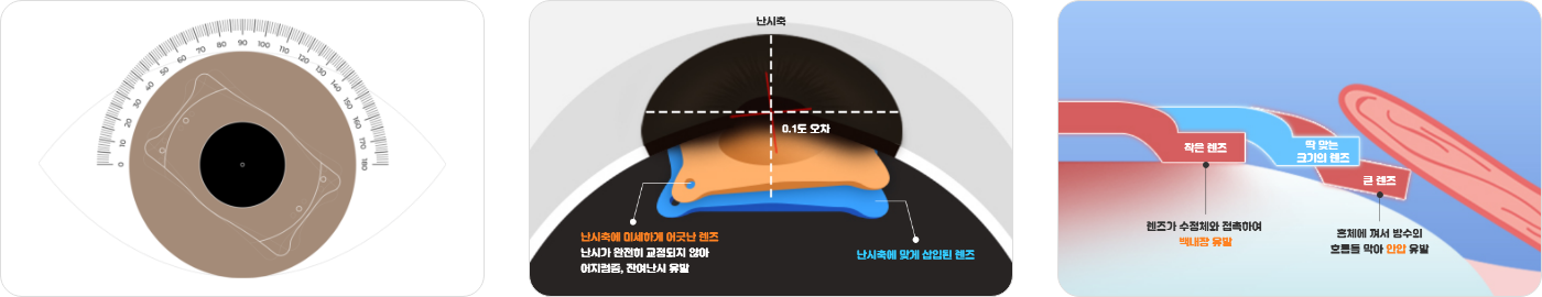 렌즈삽입술 15 1