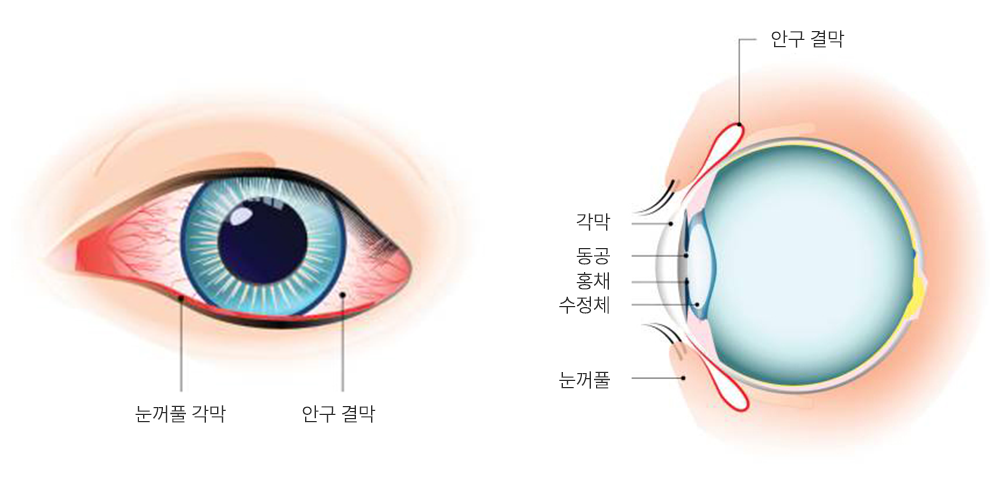 안구건조증 15 1
