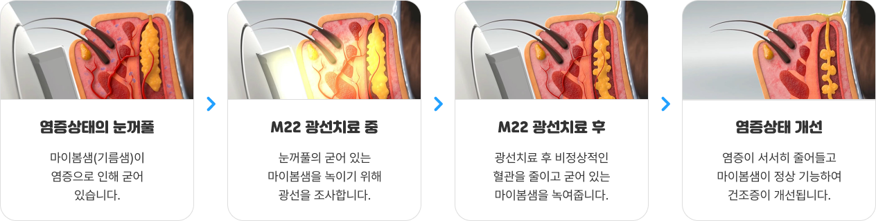 안구건조증 39 1
