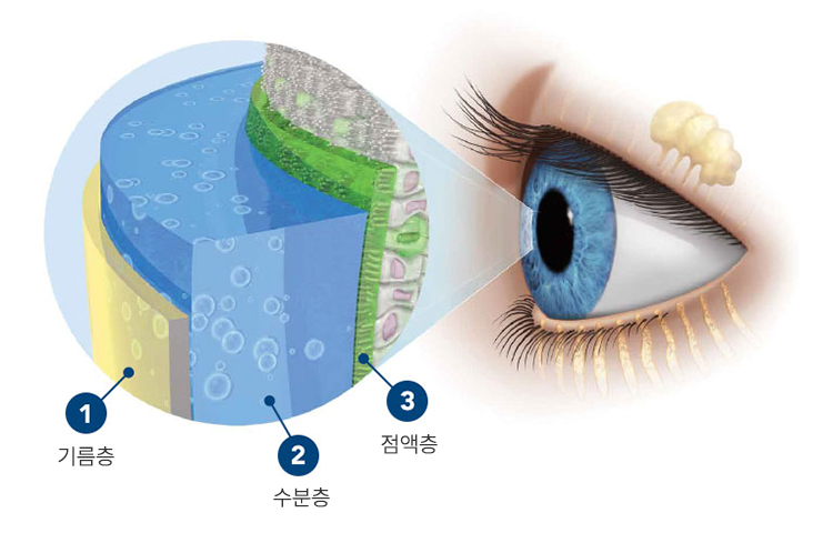 안구건조증 4 1
