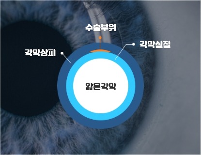 투데이 라섹